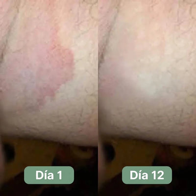 Jabón Antifúngico Veloma®