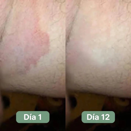 Jabón Antifúngico Veloma®