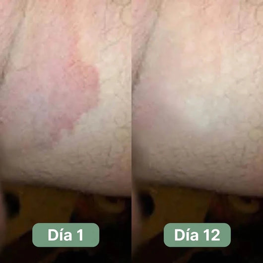 Jabón Antifúngico Veloma®