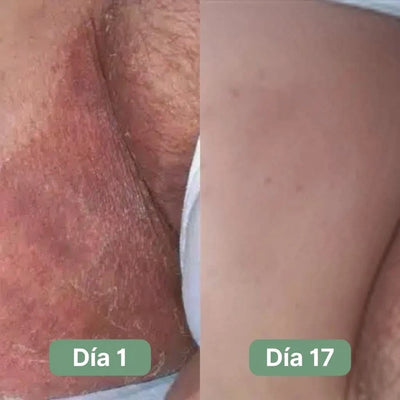 Jabón Antifúngico Veloma®