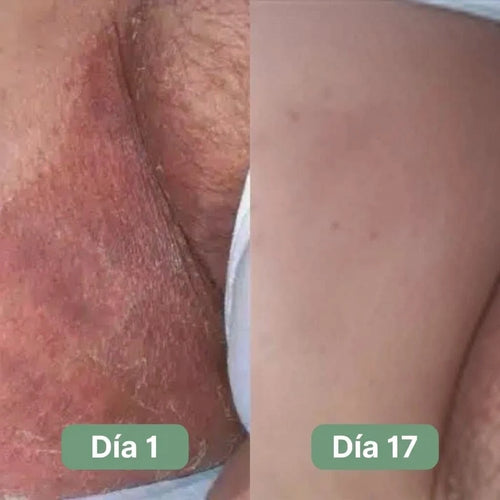 Jabón Antifúngico Veloma®